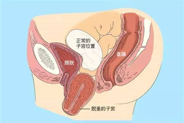 【產(chǎn)后修復】盆腔臟器脫垂，你有嗎？