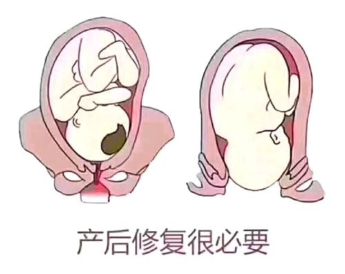產(chǎn)后恢復(fù)項(xiàng)目好不好，兩大指標(biāo)尤為關(guān)鍵