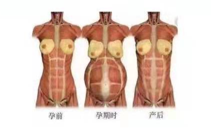 小巧便攜式產后康復治療儀，跟腹直肌分離說拜拜