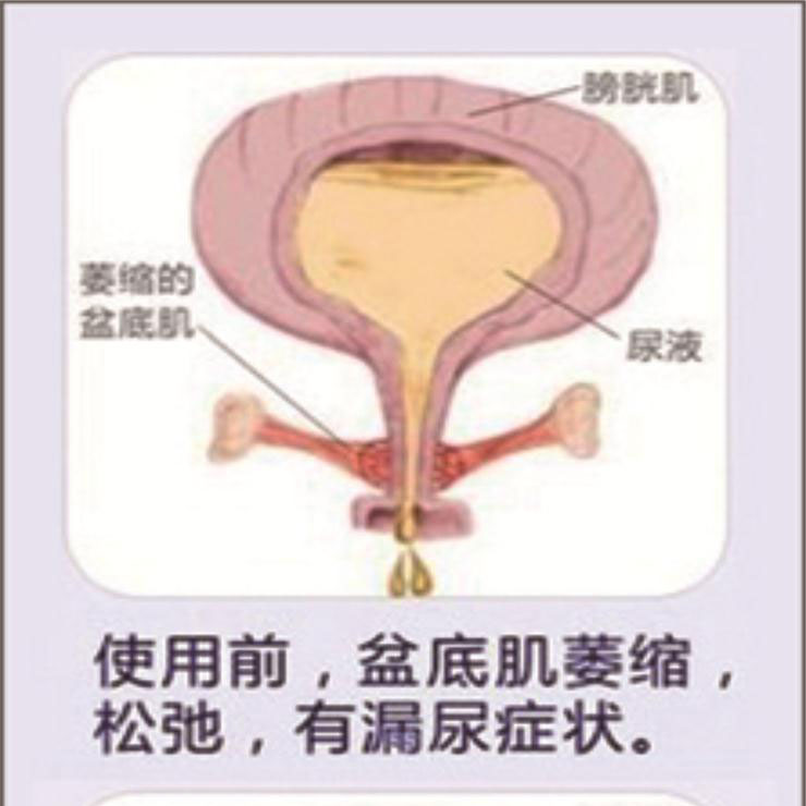產(chǎn)后盆底肌康復(fù)|“社交癌”盯上你了嗎？
