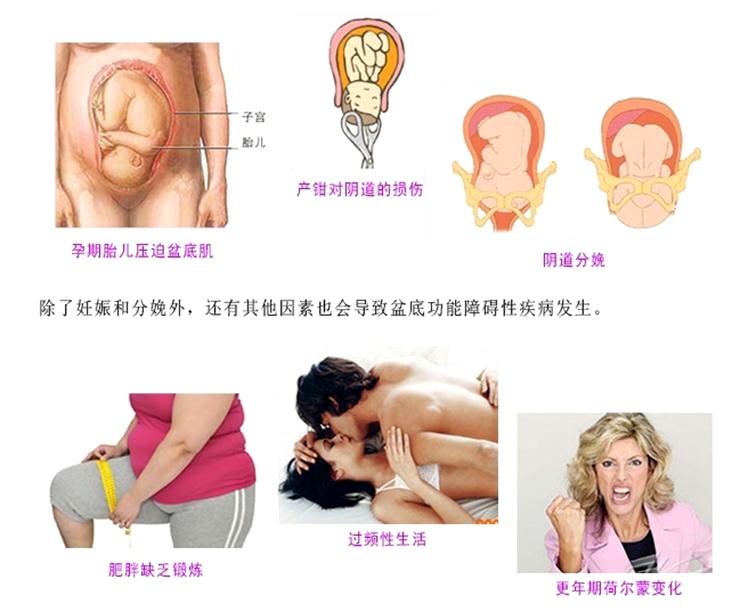 產(chǎn)后康復(fù)治療很重要，慢性盆腔痛很重要