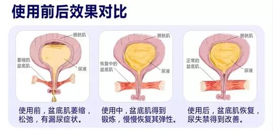 盆底康復治療怎么做？產后盆底功能檢測很重要