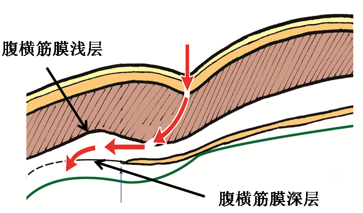 產(chǎn)后腹直肌分離如何康復(fù)，腹直肌修復(fù)那點事