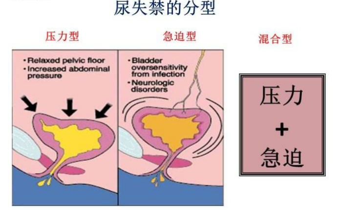 產(chǎn)后盆底肌怎么修復(fù)|尿失禁的類型，傻傻分不清