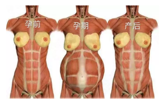 產(chǎn)婦不要隨意大吃大喝，腹直肌分離修復(fù)不太容易