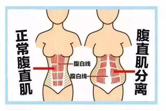 你所不知道的產后腹直肌如何康復，通澤產康為您解答