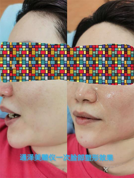 產(chǎn)后塑形溶脂瘦身儀器，美容院產(chǎn)康店的專用儀器