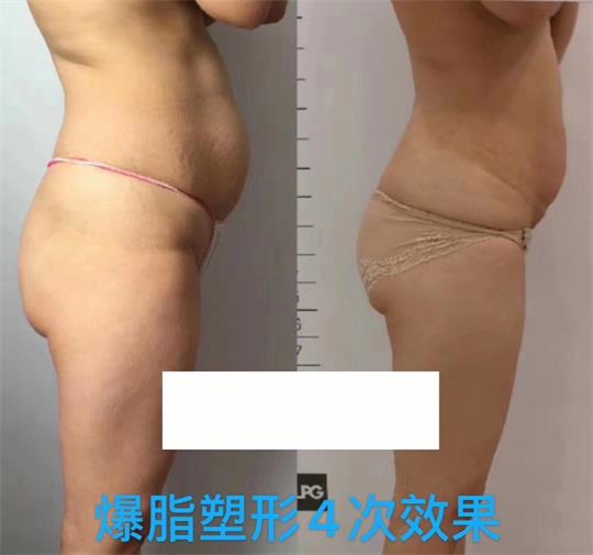 產(chǎn)后塑形美雕儀，生完孩子真的很難恢復(fù)身材？未必……
