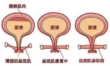 尿頻尿急尿不盡？或者可以試試盆底肌修復儀器電刺激