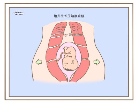 腹直肌分離可以使用盆底肌修復儀器嗎？