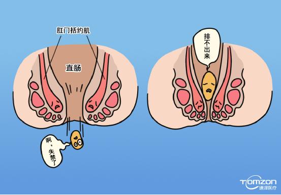 盆底康復(fù)治療儀是否可以體現(xiàn)針對(duì)性的效果？