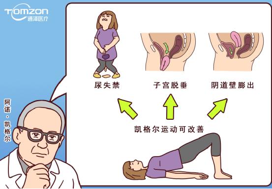使用凱格爾球還能做盆底治療儀嗎？
