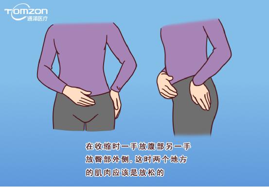 盆底康復治療儀能不能改善腹直肌分離？