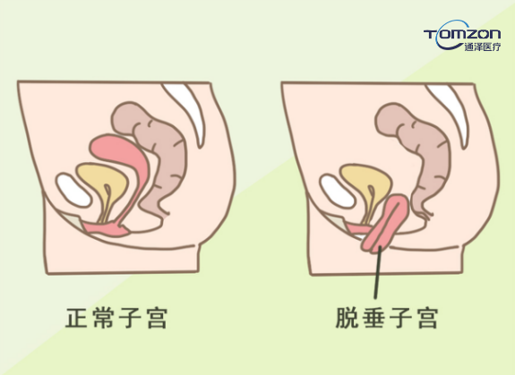 盆底康復(fù)治療儀能夠改善什么樣的情況？